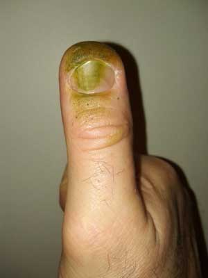 The defoliating tool (my thumb)
